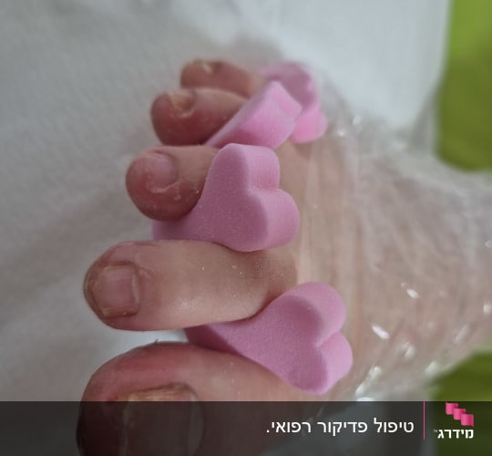אצבעות רגליים עם מפרידי ספוג ורוד לטיפוח